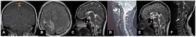 Cerebral venous thrombosis caused by spontaneous intracranial hypotension due to spontaneous spinal cerebrospinal fluid leakage in the high cervical region: a case report